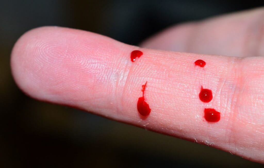 Snake bite on finger